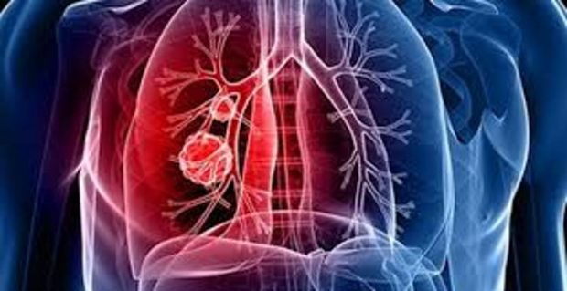 Sinsi bir hastalık “akciğer kanseri”